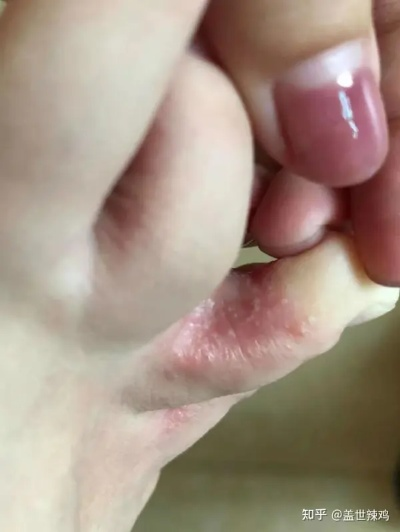 脚上起小水泡还很痒是什么原因（脚上起小水泡很痒是怎么回）
